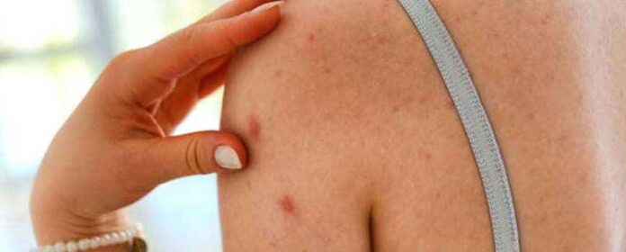 Back Acne: Types, Causes, and How to Prevent It?