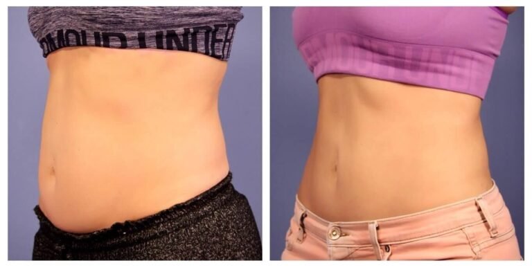 How Long Does It Take to See Results from Coolsculpting?