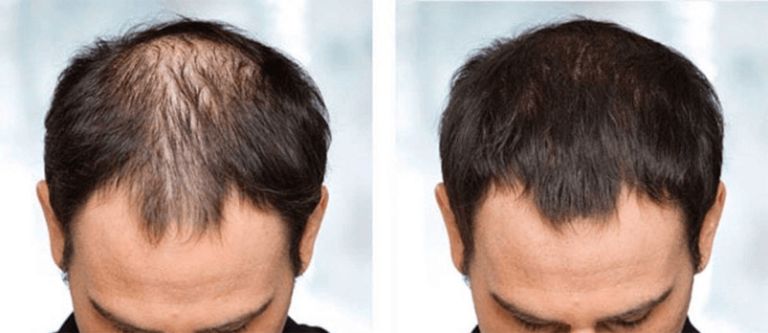 How to Tell If a Hair Loss Treatment Is Right for You?