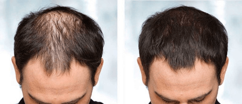Hair Loss treatments Webster Tx